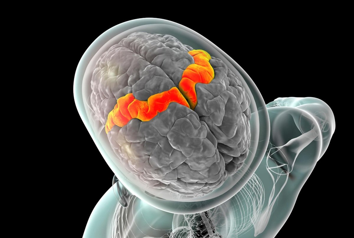 Pertama Kali, Implan Otak Berhasil Buat Pasien ALS Kembali Bisa Bicara dan Menyanyi