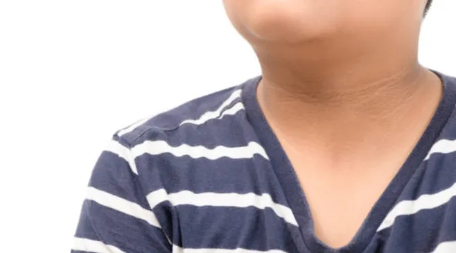 Leher Hitam Bisa Jadi Tanda Awal Diabetes, Kenali Acanthosis Nigricans!