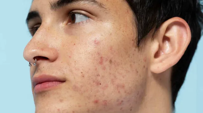 10 Cara Menghilangkan Jerawat dengan Bahan Alami, Bisa Pakai Bawang Putih