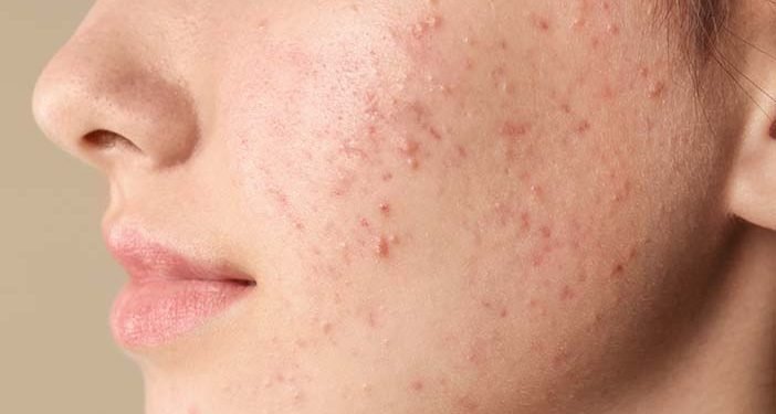 Cara Menghilangkan Bruntusan pada Wajah Secara Alami