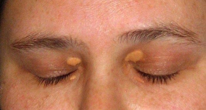 Penyebab Timbulnya Lemak di Mata dan Cara Mengatasinya