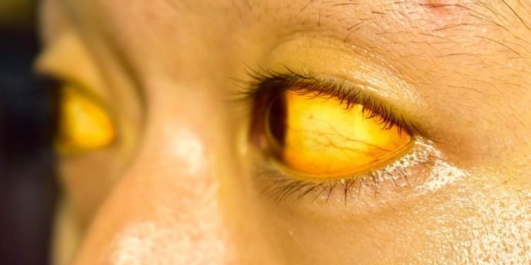 9 Ciri Ciri Mengidap Penyakit Kuning dan Cara Mengatasinya