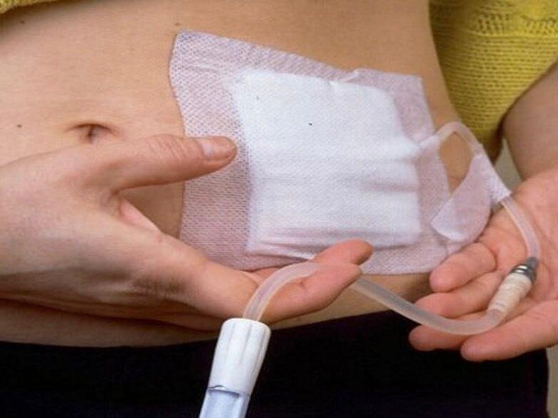 Kenapa Seseorang Pakai Alat CAPD di Perutnya? 